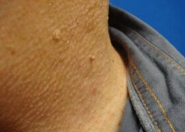 νηματοειδή θηλώματα στο λαιμό